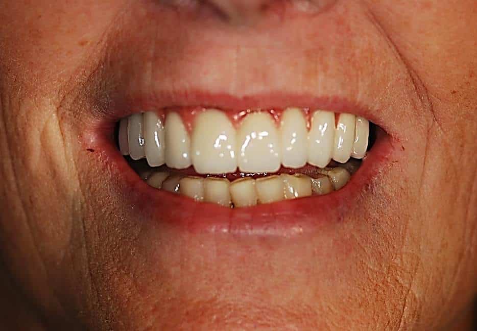 After: Implant Supported Reconstruction